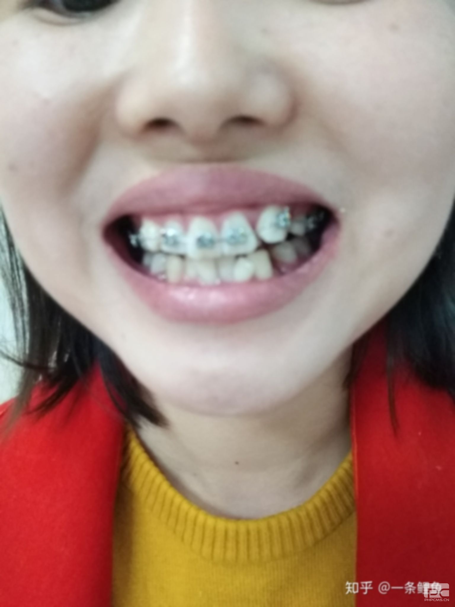 40歲了有蛀牙怎么辦?四十幾歲蛀牙了怎么辦?滿口蛀牙 40歲了有蛀牙怎么辦?四十幾歲蛀牙了怎么辦?滿口蛀牙