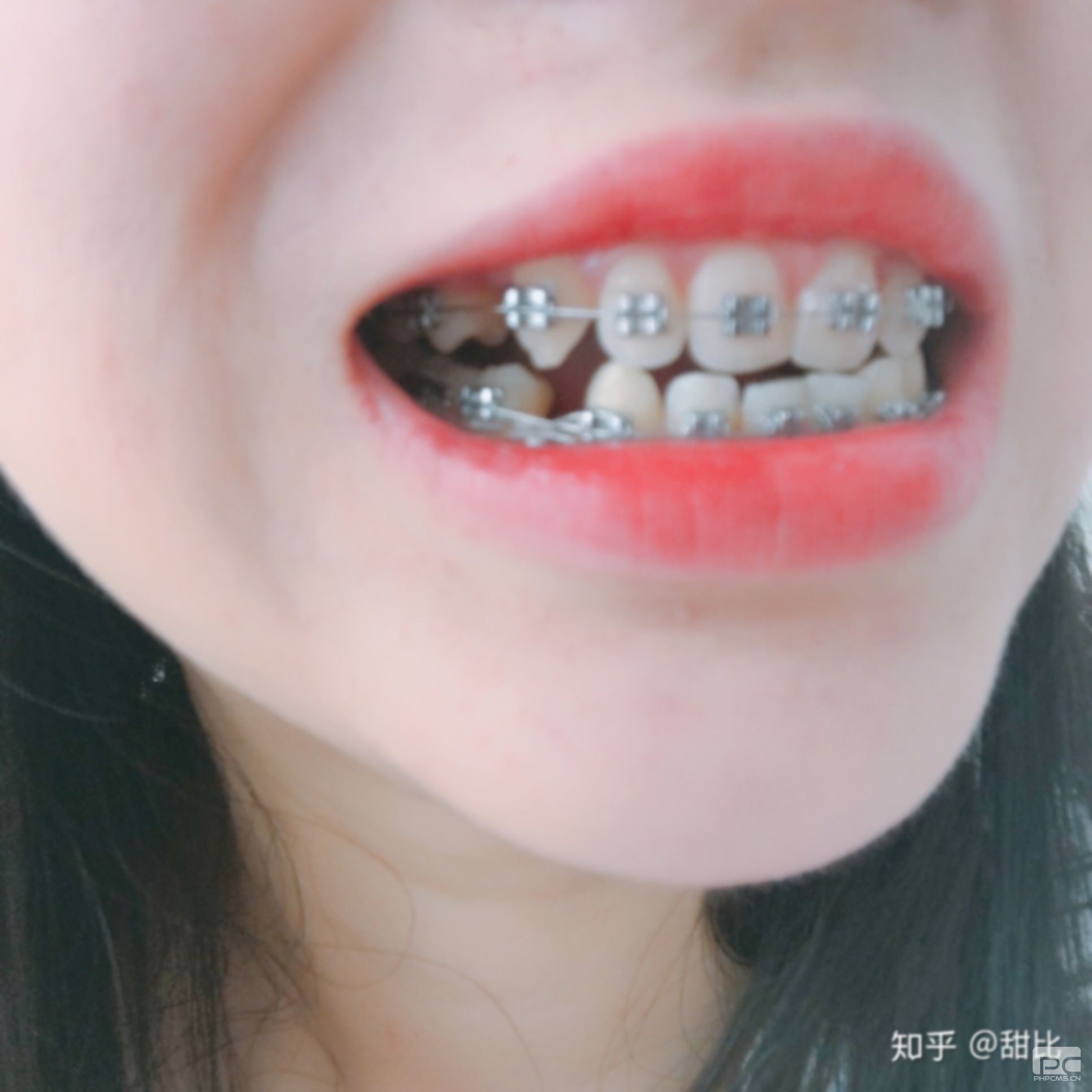 拔完牙多久可以戴牙套,牙后多久才可以戴牙套,能戴牙套 拔完牙多久可以戴牙套,牙后多久才可以戴牙套,能戴牙套