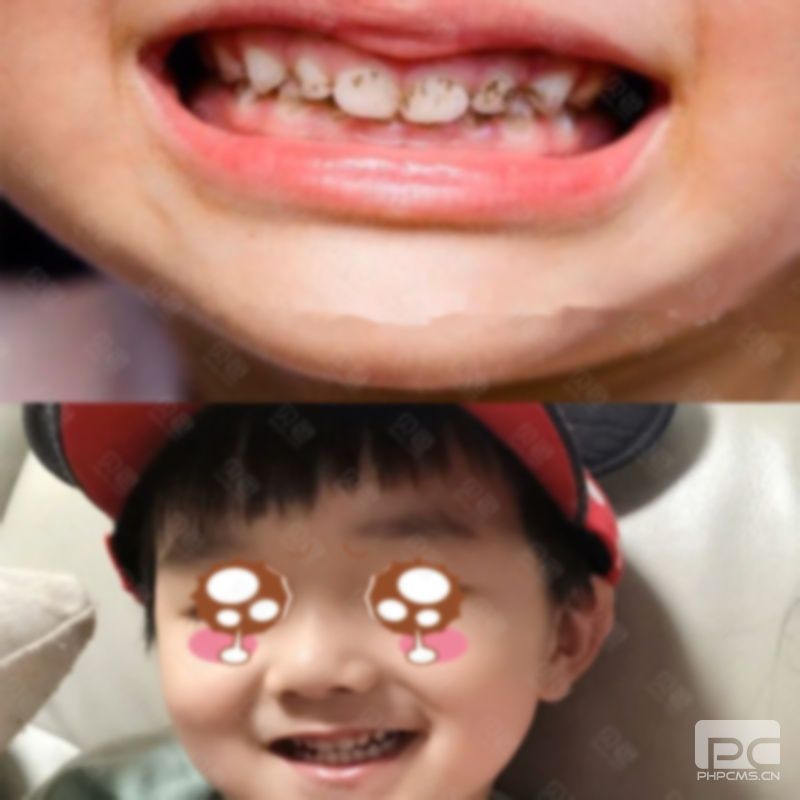 兒童牙齒矯正一顆門牙多少錢?八歲兒童矯正門牙多少錢?8歲兒童矯正兩顆大門牙多少錢? 兒童牙齒矯正一顆門牙多少錢?八歲兒童矯正門牙多少錢?8歲兒童矯正兩顆大門牙多少錢?