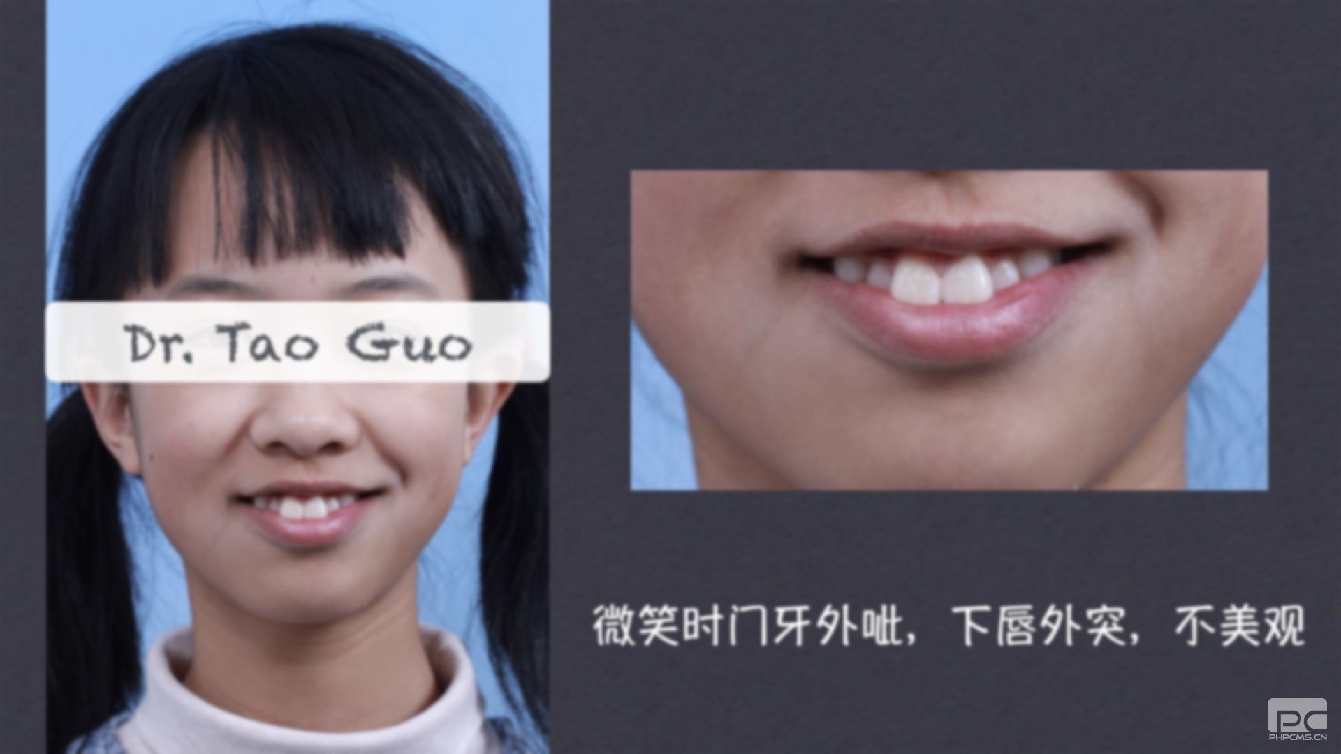 齙牙成人矯正牙齒臉型變化圖,正畸牙齒后臉型變化圖,牙齒矯正臉型變化圖 齙牙成人矯正牙齒臉型變化圖,正畸牙齒后臉型變化圖,牙齒矯正臉型變化圖
