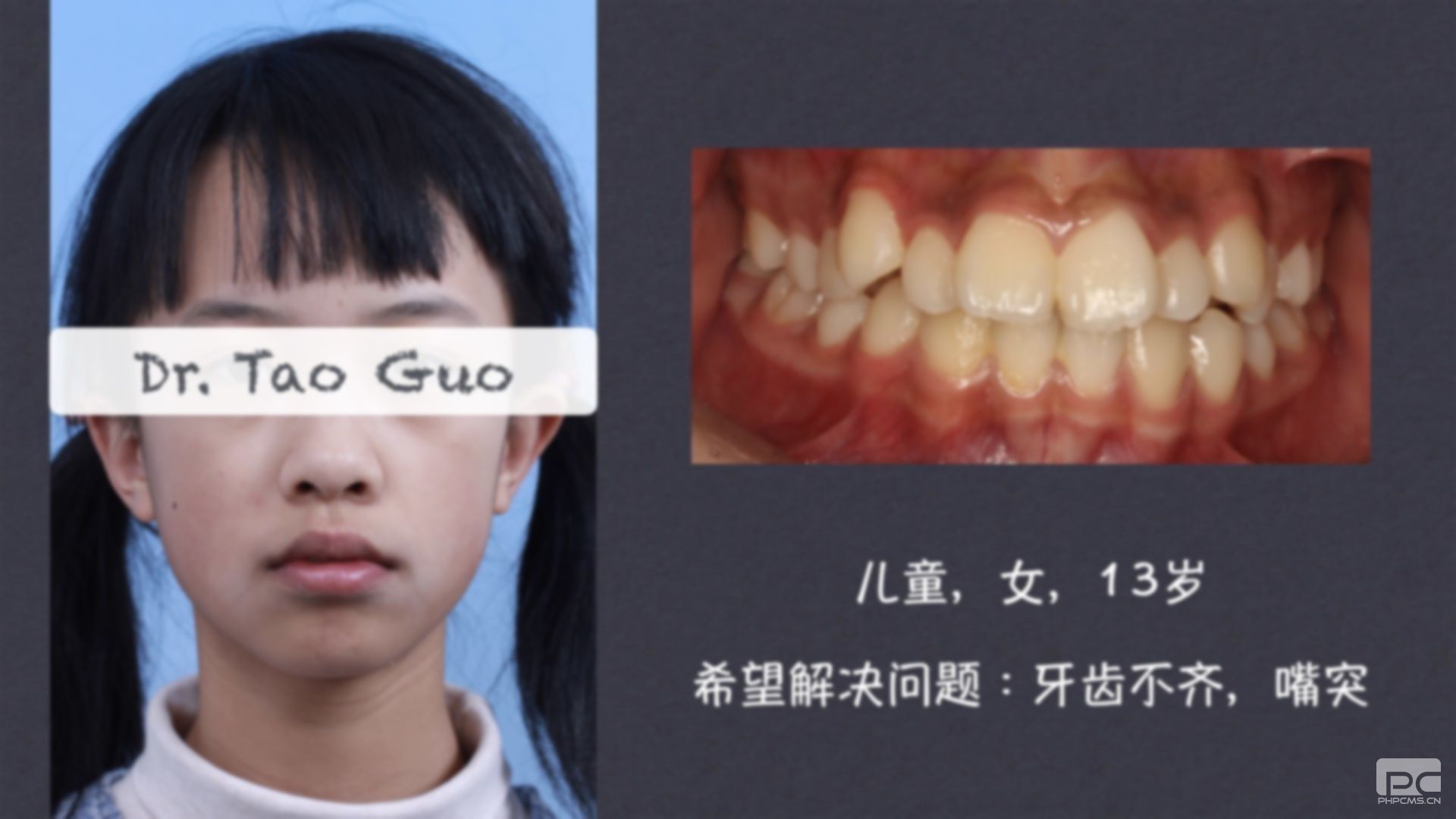 齙牙矯正后的樣子,之后臉型,側(cè)臉變化 齙牙矯正后的樣子,之后臉型,側(cè)臉變化