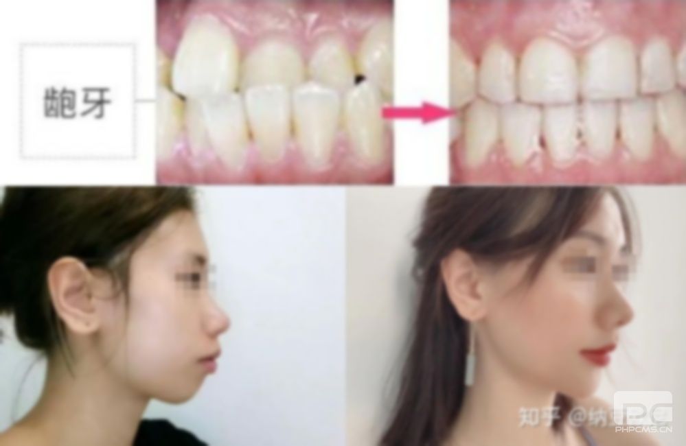 龅牙矫正可以改善凸嘴吗多少钱?图片?50岁龅牙矫正可以改善凸嘴吗? 龅牙矫正可以改善凸嘴吗多少钱?图片?50岁龅牙矫正可以改善凸嘴吗?