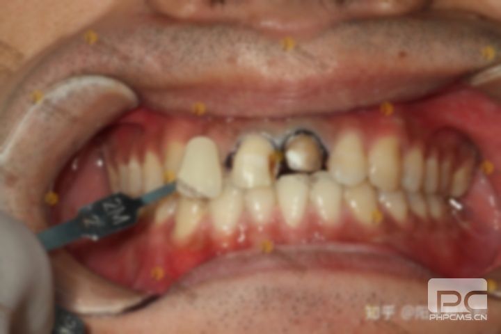 门牙龅牙做烤瓷牙效果图,龅牙做烤瓷牙效果图片,龅牙换烤瓷牙效果图 门牙龅牙做烤瓷牙效果图,龅牙做烤瓷牙效果图片,龅牙换烤瓷牙效果图