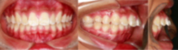 矯正牙齒以后嘴凸了,不拔牙矯正后嘴巴凸了,沒拔牙整牙后嘴凸 矯正牙齒以后嘴凸了,不拔牙矯正后嘴巴凸了,沒拔牙整牙后嘴凸