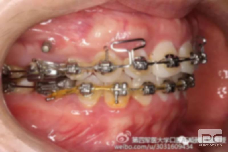 8歲孩子牙齒可以矯正嗎?的孩子牙齒可以矯正嗎?八歲孩子牙齒可以矯正嗎? 8歲孩子牙齒可以矯正嗎?的孩子牙齒可以矯正嗎?八歲孩子牙齒可以矯正嗎?