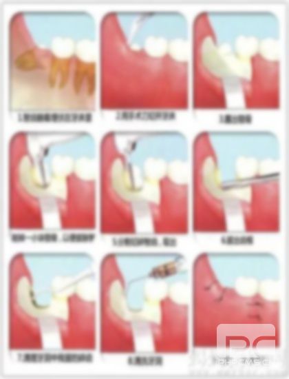 拔智齒會(huì)影響到其他牙齒嗎?牙智齒會(huì)影響其他牙齒嗎?其它牙齒嗎? 拔智齒會(huì)影響到其他牙齒嗎?牙智齒會(huì)影響其他牙齒嗎?其它牙齒嗎?