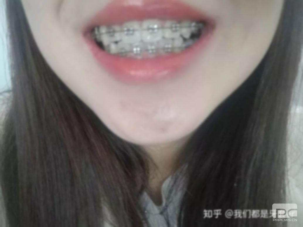 拔牙后矫正牙齿后脸会小吗?矫正牙齿脸会变小吗?整牙脸会变小吗? 拔牙后矫正牙齿后脸会小吗?矫正牙齿脸会变小吗?整牙脸会变小吗?