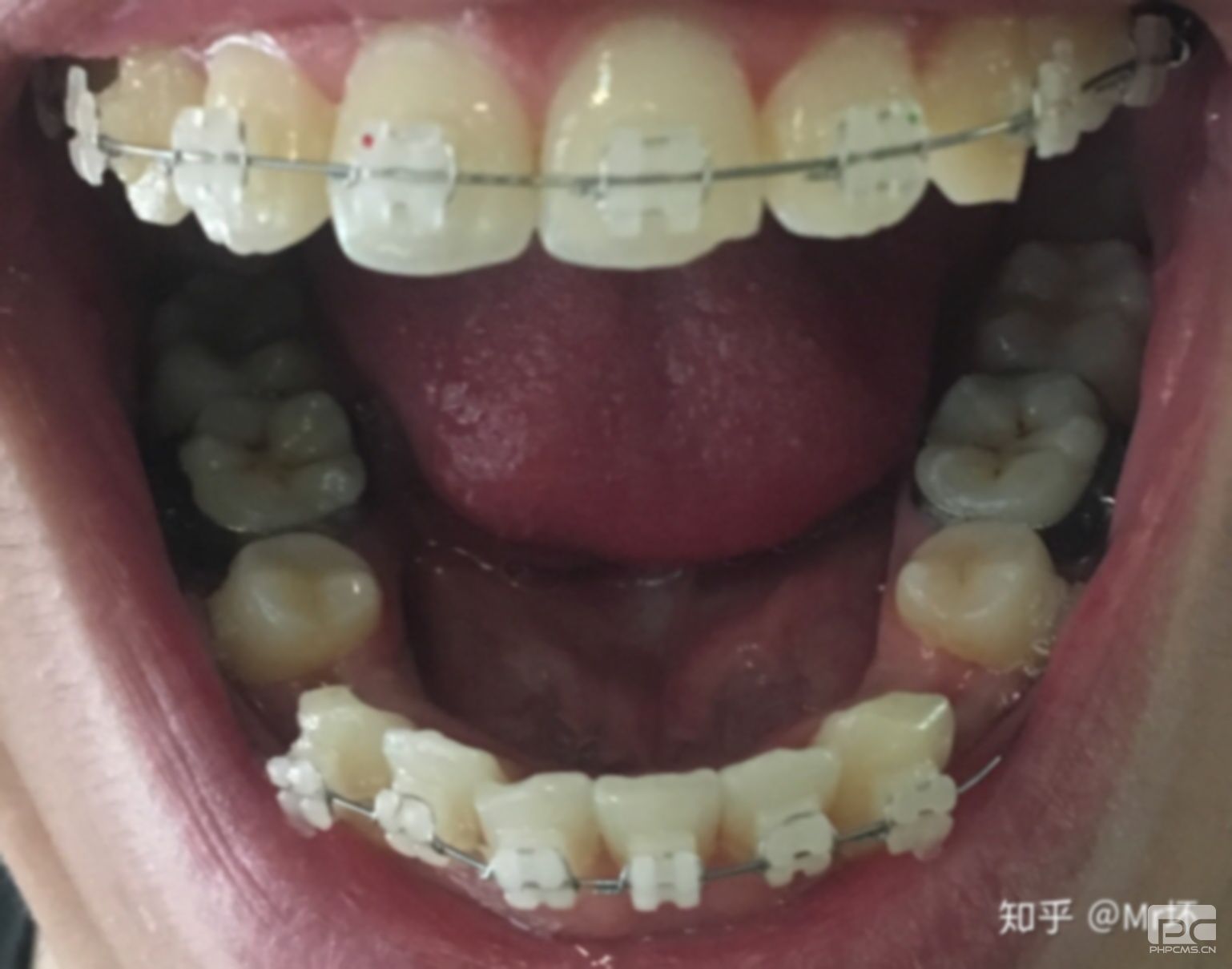牙齿龅牙矫正费用,龅牙牙齿矫正费用,龅牙矫正费用多少? 牙齿龅牙矫正费用,龅牙牙齿矫正费用,龅牙矫正费用多少?