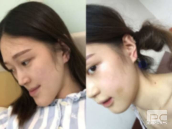 五十歲可以做正頜手術(shù)嗎?四十歲正頜手術(shù)還有必要嗎?30多歲還能做正頜手術(shù)嗎?