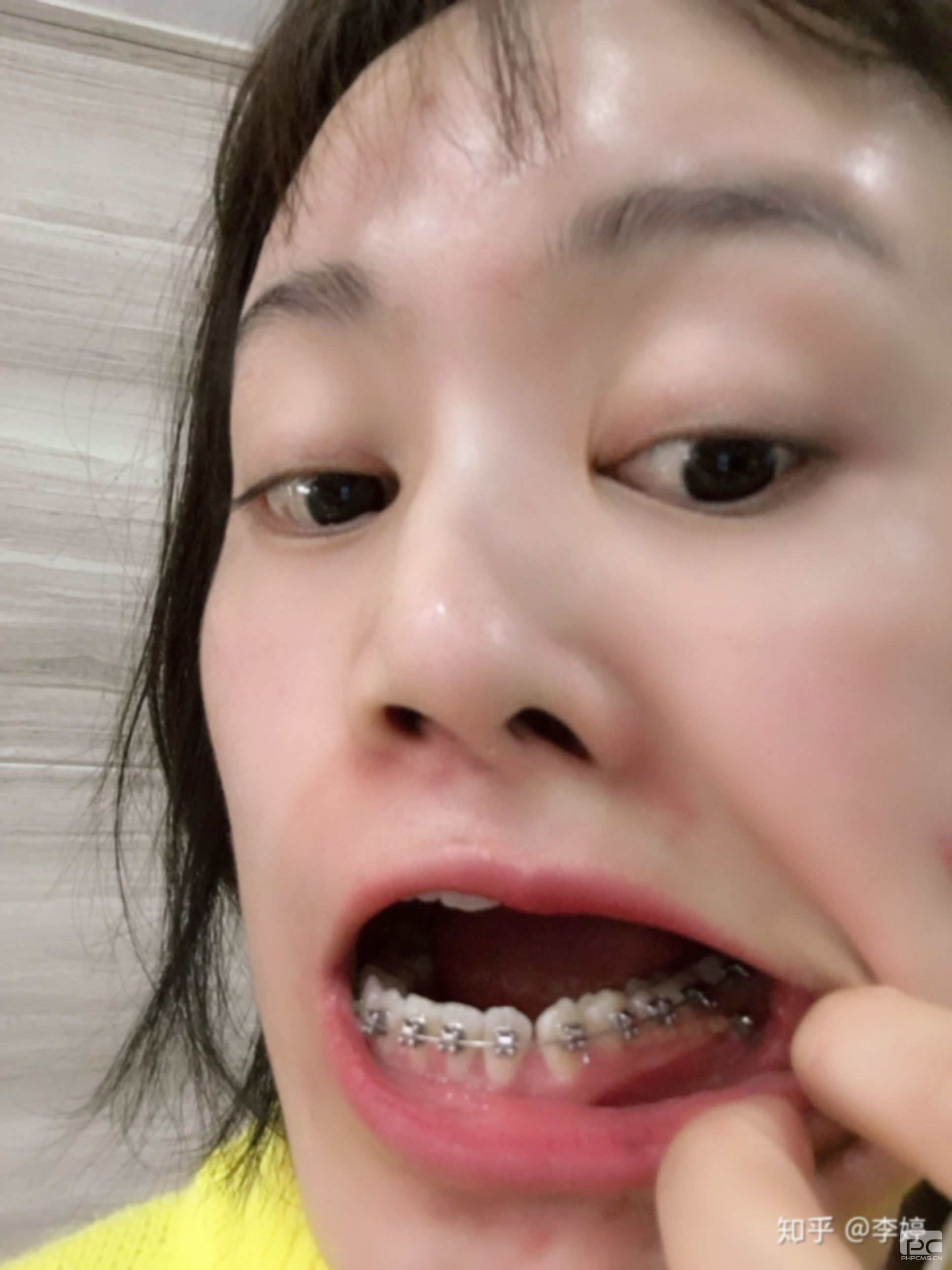 35歲地包天還有必要矯正嗎?40歲地包天還能矯正嗎?四十歲地包天還能矯正嗎? 35歲地包天還有必要矯正嗎?40歲地包天還能矯正嗎?四十歲地包天還能矯正嗎?