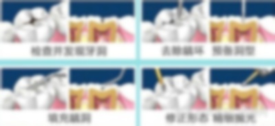 3m樹脂補(bǔ)牙和樹脂補(bǔ)牙的區(qū)別,進(jìn)口和國產(chǎn)的區(qū)別,250和350的區(qū)別