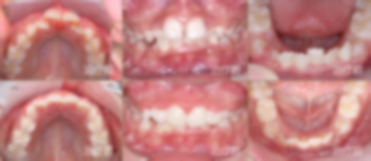 龅牙怎么自我矫正?自己矫正牙齿?在家怎么矫正? 龅牙怎么自我矫正?自己矫正牙齿?在家怎么矫正?