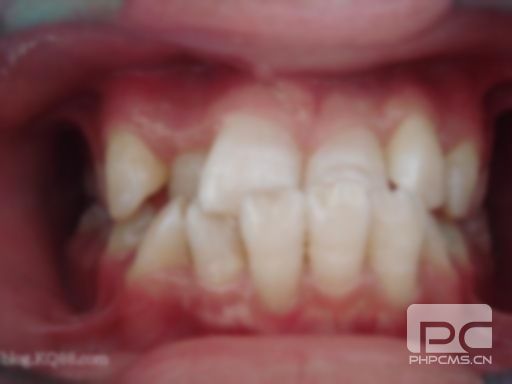 三甲医院拔埋伏牙多少钱?拔个埋伏牙要多少钱?拔埋伏多生牙多少钱? 三甲医院拔埋伏牙多少钱?拔个埋伏牙要多少钱?拔埋伏多生牙多少钱?