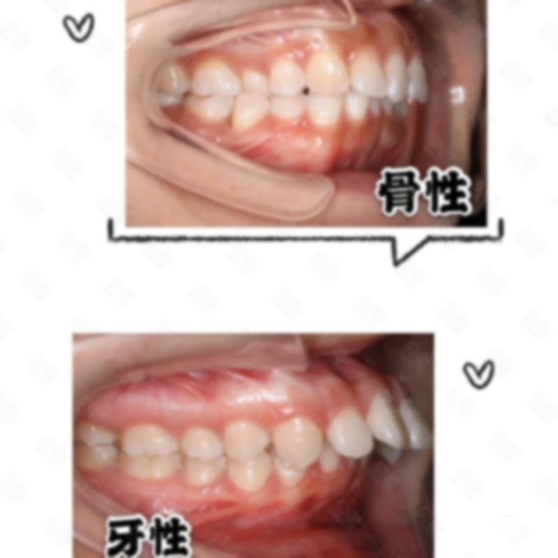 龅牙矫正大概要花费多少钱?怎么矫正?怎么快速矫正? 龅牙矫正大概要花费多少钱?怎么矫正?怎么快速矫正?