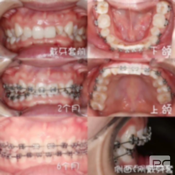 40歲牙齒還能矯正嗎?了牙齒還能矯正嗎?40多歲牙還能矯正嗎?