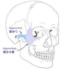 顴骨整形