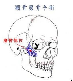 磨顴骨