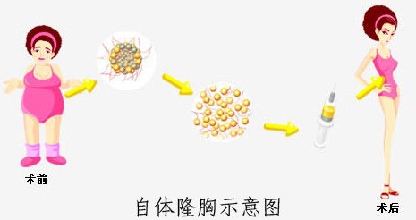 自體脂肪隆胸