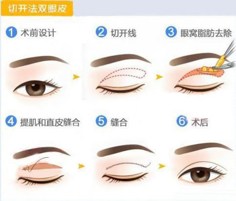 切開雙眼皮