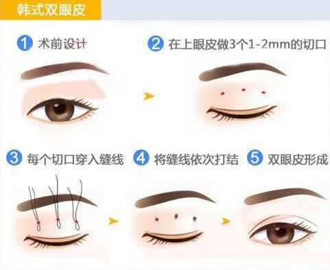 韓式雙眼皮