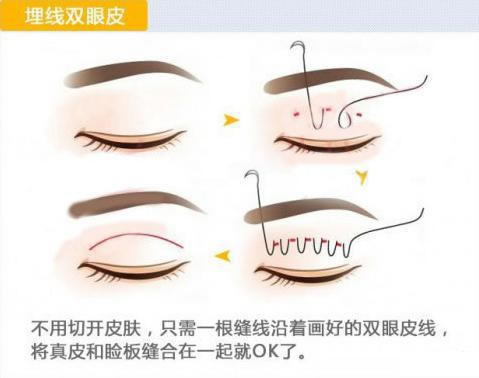 埋線雙眼皮