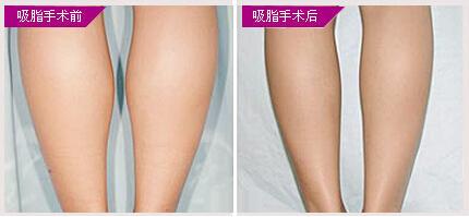 吸脂瘦腿