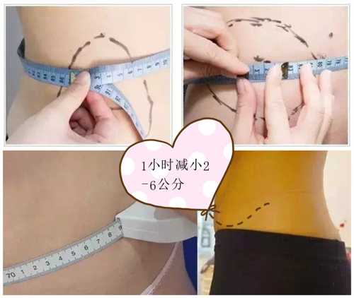 優(yōu)立塑溶脂減肥效果