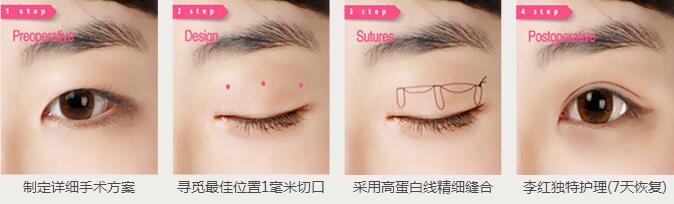李紅明星專家埋線法雙眼皮