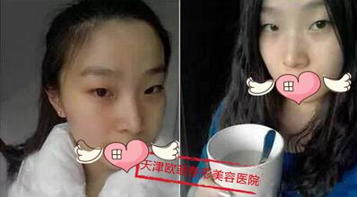 在天津歐菲整形醫(yī)院做雙眼皮前照片