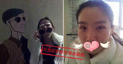 在天津歐菲整形醫(yī)院做雙眼皮手術拆紗布后照片