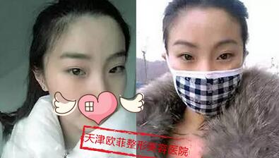 在天津歐菲整形醫(yī)院做雙眼皮后照片