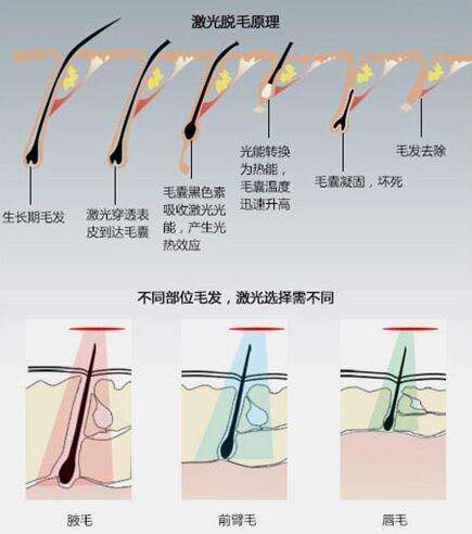 激光脫毛原理
