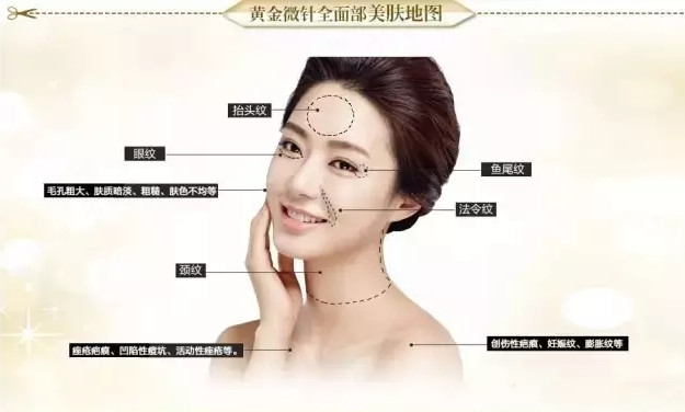 石家莊巍名仕除皺新儀器黃金微針，解決各種皮膚問(wèn)題， 專(zhuān)治不漂亮!