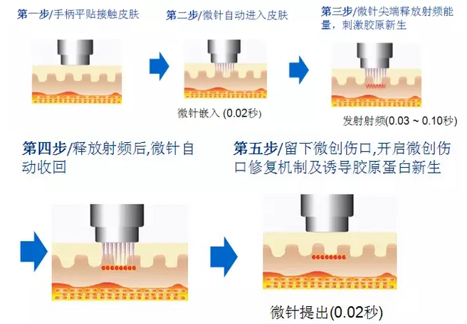 石家莊巍名仕黃金微針治療步驟