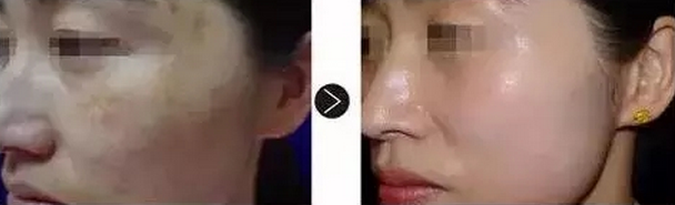 石家莊巍名仕除皺新儀器黃金微針治療效果對(duì)比圖