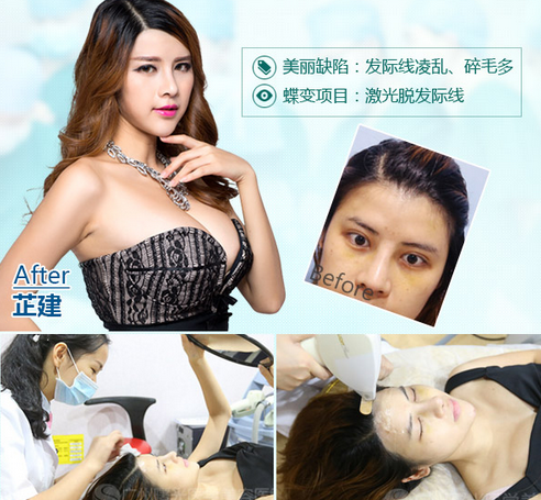 脱毛调整发际线，芷建轻松摆脱烦恼