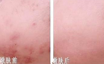 <i data-id=69d5c462-268b-4c8b-b817-8b2b79b4ec5a></i>医院彩光嫩肤祛斑效果图