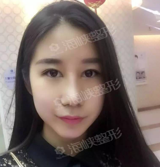 90后空姐在福州海峽做鼻綜合+注射隆下巴后第7天