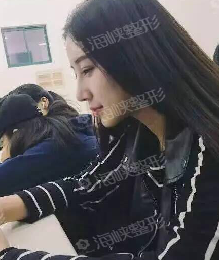 90后空姐在福州海峽做鼻綜合+注射隆下巴后第40天