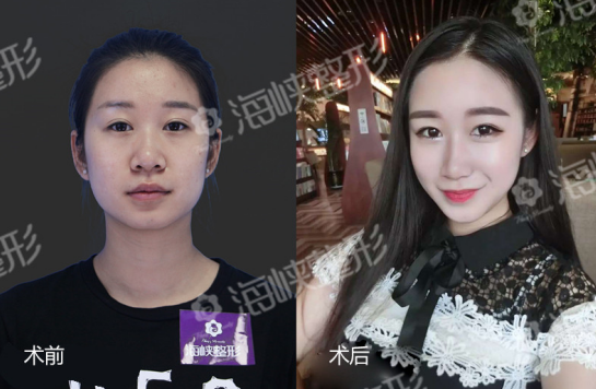 90后空姐在福州海峽做鼻綜合+注射隆下巴后整形對(duì)比圖