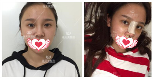 南京连天美整形周长兵做眼综合+鼻综合术前及术后第5天效果