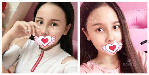 南京连天美整形周长兵做眼综合+鼻综合术后25天效果
