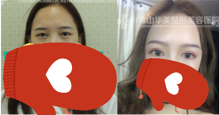 佛山华美罗宇康院长精雕双眼皮案例效果