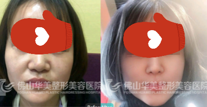 佛山华美刘安堂医生韩式隆鼻真人案例效果图