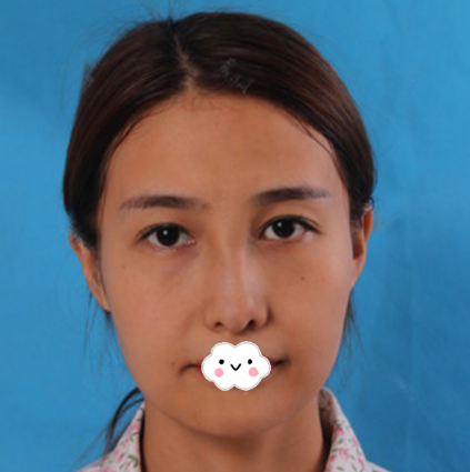 在北京美莱做脂肪填充术前照片