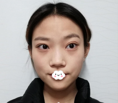 在深圳润泽瑞尼丝做肋骨鼻综合术前照片