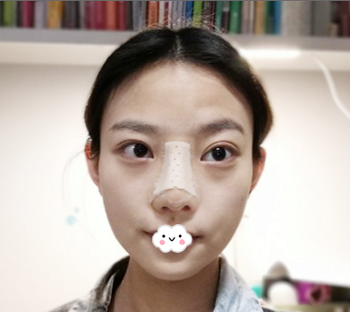 肋骨鼻综合3天恢复过程图