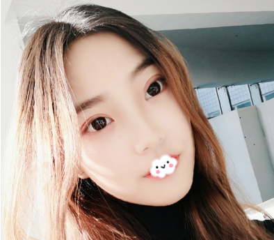 李忠医生肋软骨隆鼻术后15天案例效果