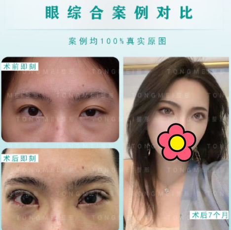 劉鳳卓雙眼皮修復(fù)案例