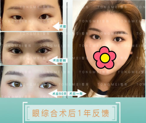 劉鳳卓修復(fù)雙眼皮怎么樣